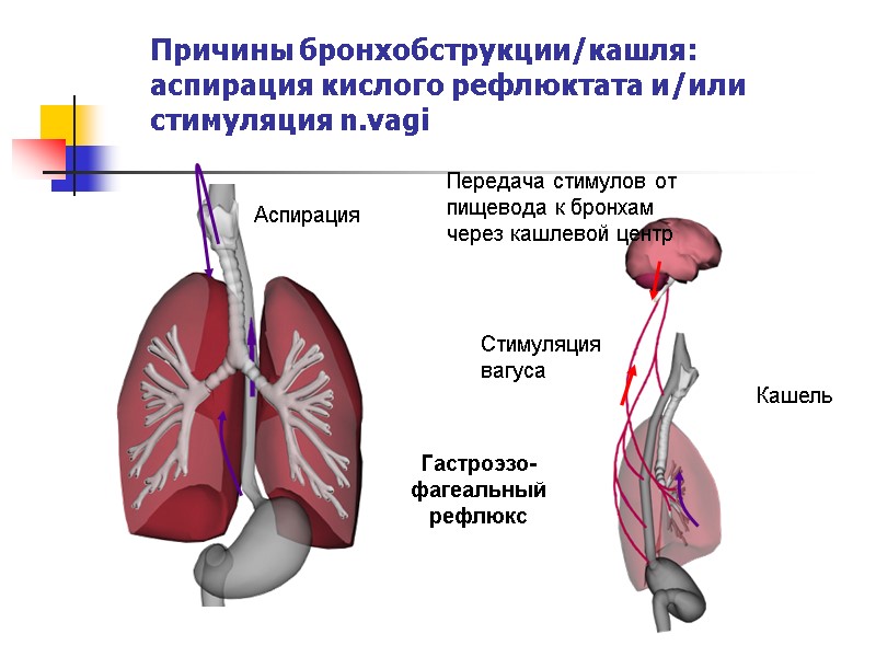Кашель Стимуляция вагуса Гастроэзо-фагеальный рефлюкс Передача стимулов от пищевода к бронхам через кашлевой центр